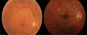 retinpathy